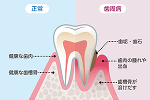 歯周病とは